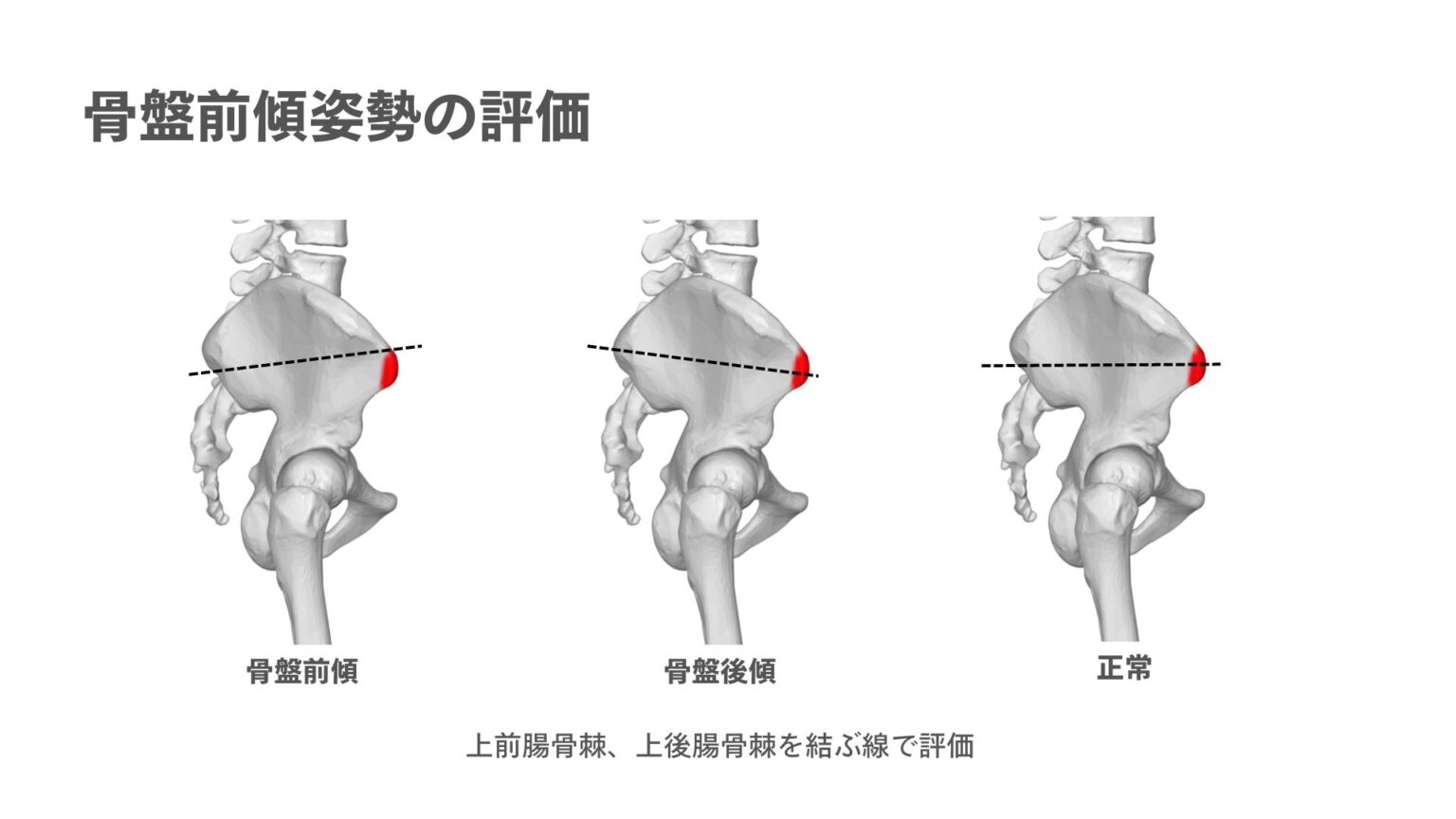 骨盤前傾姿勢は「修正」すべきですか？ | シゲトレブログ