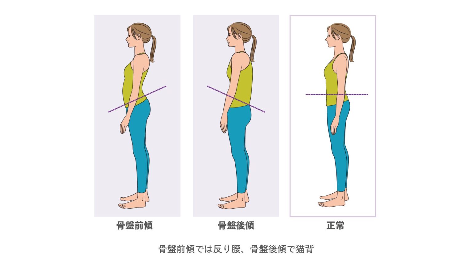 骨盤前傾姿勢は「修正」すべきですか? | シゲトレブログ